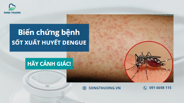Hãy Cảnh Giác Với Những Biến Chứng Nguy Hiểm Của Bệnh Sốt Xuất Huyết Dengue